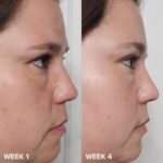 Paula’s Choice 2% BHA Liquid Exfoliant before after results in Pakistan