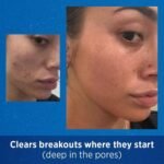 Differin Gel for acne before after