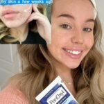 PanOxyl Acne Creamy Wash before and after results