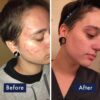 PanOxyl Acne Foaming Wash before after results for acne