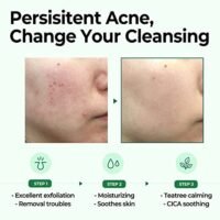 Some By Mi Miracle 30 Days Cleansing Bar results