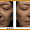 RoC Retinol Correxion Deep Wrinkle Serum before and after
