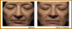 RoC Retinol Correxion Deep Wrinkle Serum before and after