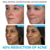 La Roche-Posay Effaclar Duo Acne Spot Treatment before after results
