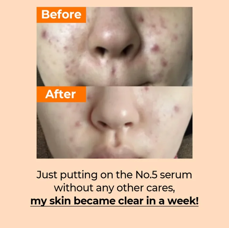 Numbuzin No.5 Vitamin Concentrated Serum before after results