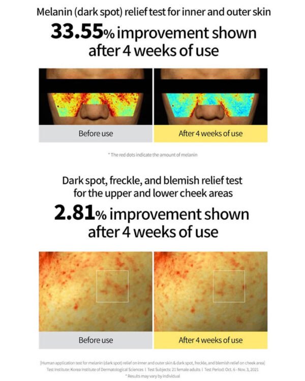 goodal – Green Tangerine vita C Dark Spot Serum 40ml before and after result