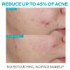 La Roche-Posay Effaclar Salicylic Acid Acne Serum before and after results