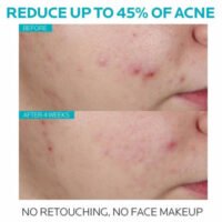 La Roche-Posay Effaclar Salicylic Acid Acne Serum before and after results
