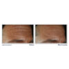 RoC Derm Correxion Fill + Treat Serum before after result