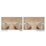 RoC Derm Correxion Fill + Treat Serum results