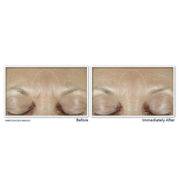 RoC Derm Correxion Fill + Treat Serum results