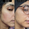 The Inkey List - Super Solutions 10 Azelaic Acid Serum before and after