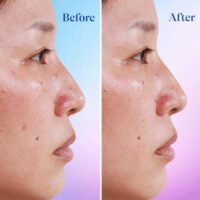 Differin Dark Spot Correcting Face Serum before after result
