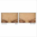 RoC Retinol Correxion® Line Smoothing Max Hydration Cream before after results