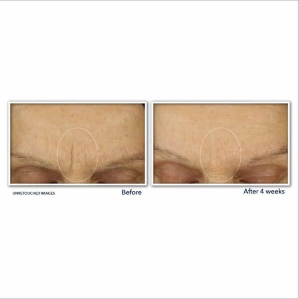 RoC Retinol Correxion® Line Smoothing Max Hydration Cream before after results